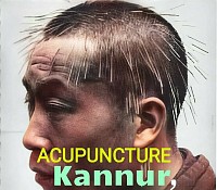 ln CHINESE ACUPUNCTURE needles used are single or many according to the case or condition of the patient, experience of the practitioner or method used